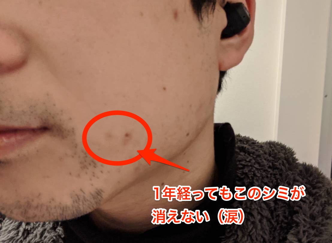 10年間髭を抜き続けた結果、、、髭を抜くのはリスクしかない! 10年間髭を抜き続けた結果、、、髭を抜くのはリスクしかない!