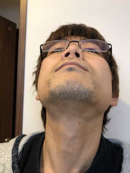 脱毛2回終了 2日後アゴ下
